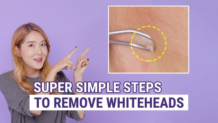 How to remove whiteheads?